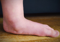 obr. 1 plochovbočená noha